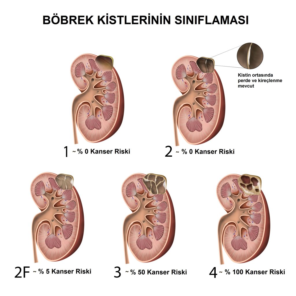 böbrek ki̇sti̇ ve tedavi̇si̇ hakkinda bi̇li̇nmesi̇ gerekenler