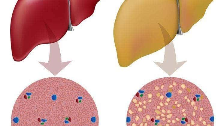 karaciğer yağlanması nedir?