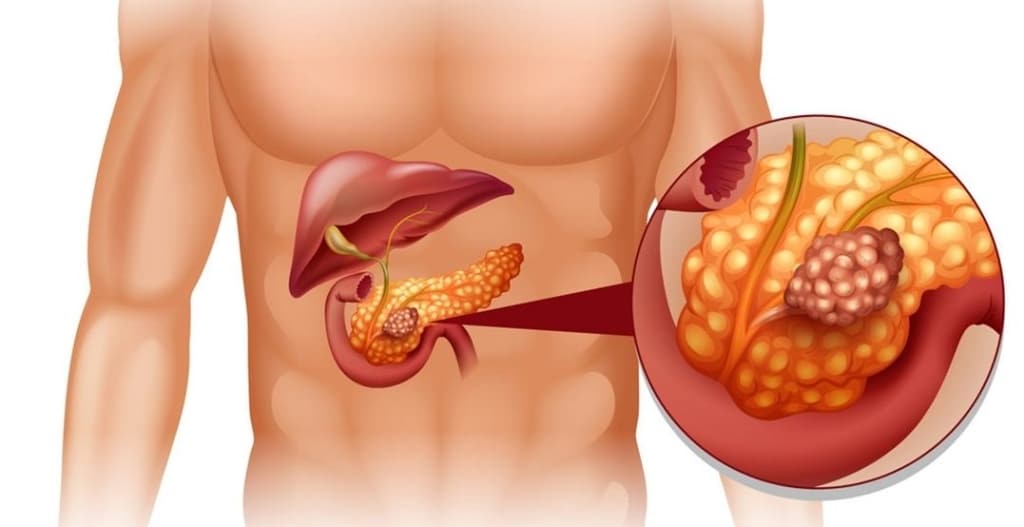 Pankreas Kanseri Nedir? pankreas kanseri nedir