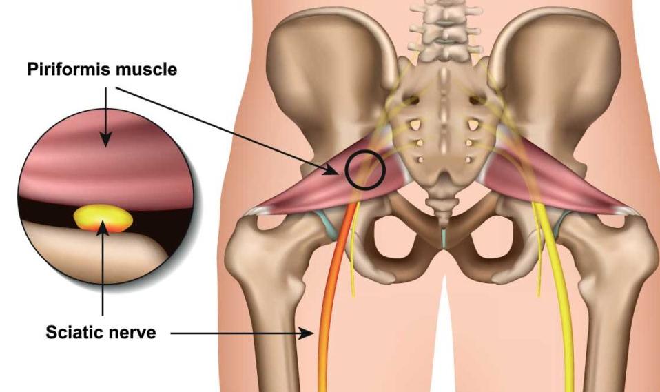 Piriformis Sendromu Nedir? Piriformis kişinin kalçasında yer alan düz bir