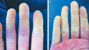 raynaud sendromu nedir?