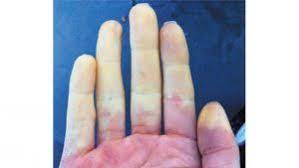 raynaud sendromu nedir?