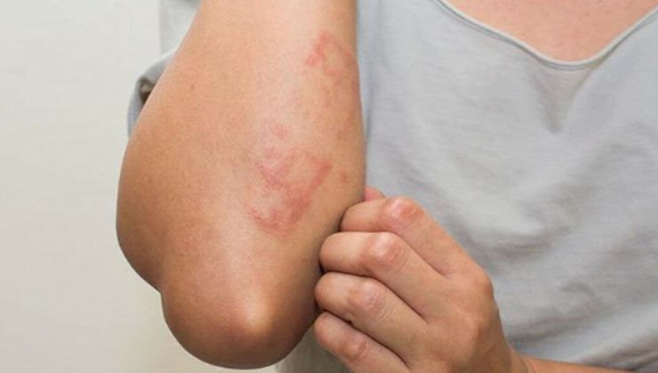 ŞARBON NEDİR? ŞARBON HASTALIĞININ SEMPTOMLARI NELERDİR? sarbon