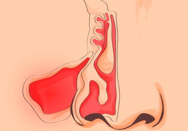 sinüzit nedir? belirtileri nelerdir? tedavisi nasıldır?