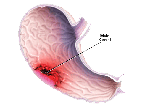 mide kanseri nedir?