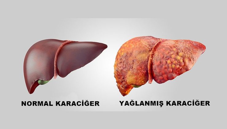 karaciğer yağlanması nedir?