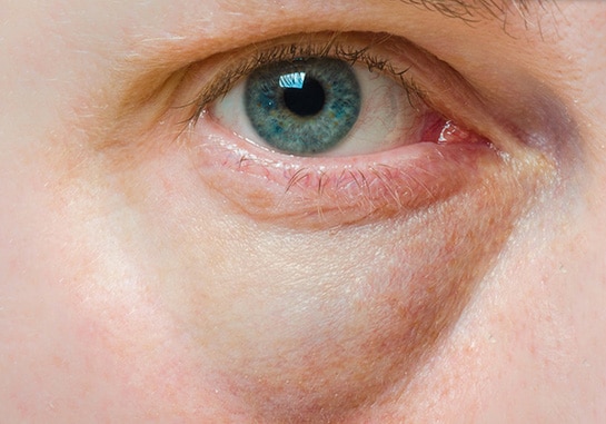 Göz Seğirmesi Neden Olur? Göz Seğirmesi Nasıl Geçer? - Sağlık Ağı