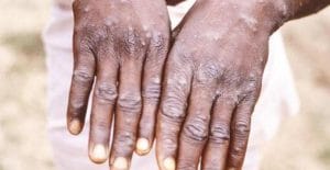 Türk Klinik Mikrobiyoloji ve İnfeksiyon Hastalıkları Derneği (KLİMİK) çatısı altındaki