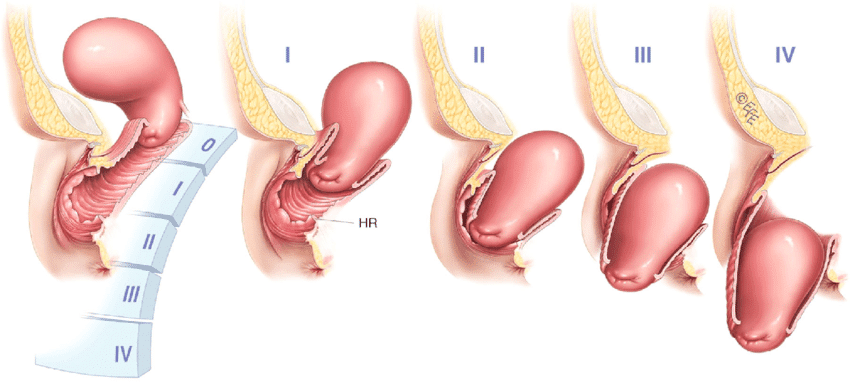 shows prolapse staging 4 0 i ii iii iv uterine by the position of the leading edge
