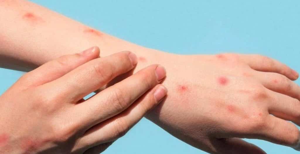 dso maymun cicegi temaslisi olanlara seyahat uyarisinda bulundu