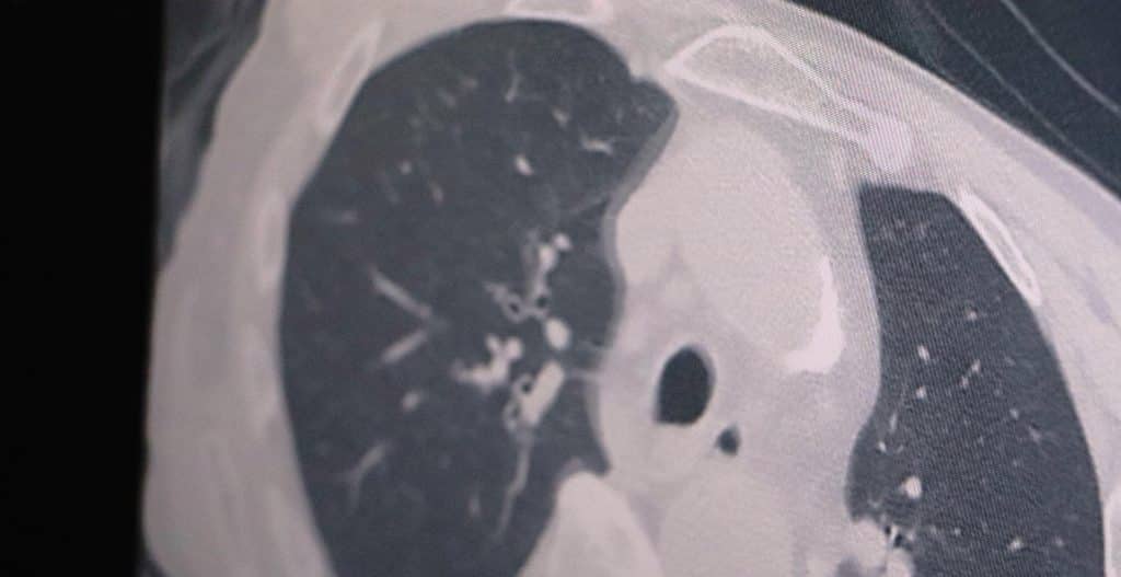 Kovid Vaka Sayısı 3 Kat Arttı kovid vaka sayisi 3 kat artti