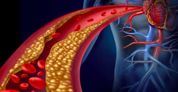 ailesel kolesterol yuksekligi ciddi saglik sorunlarina neden olabilir