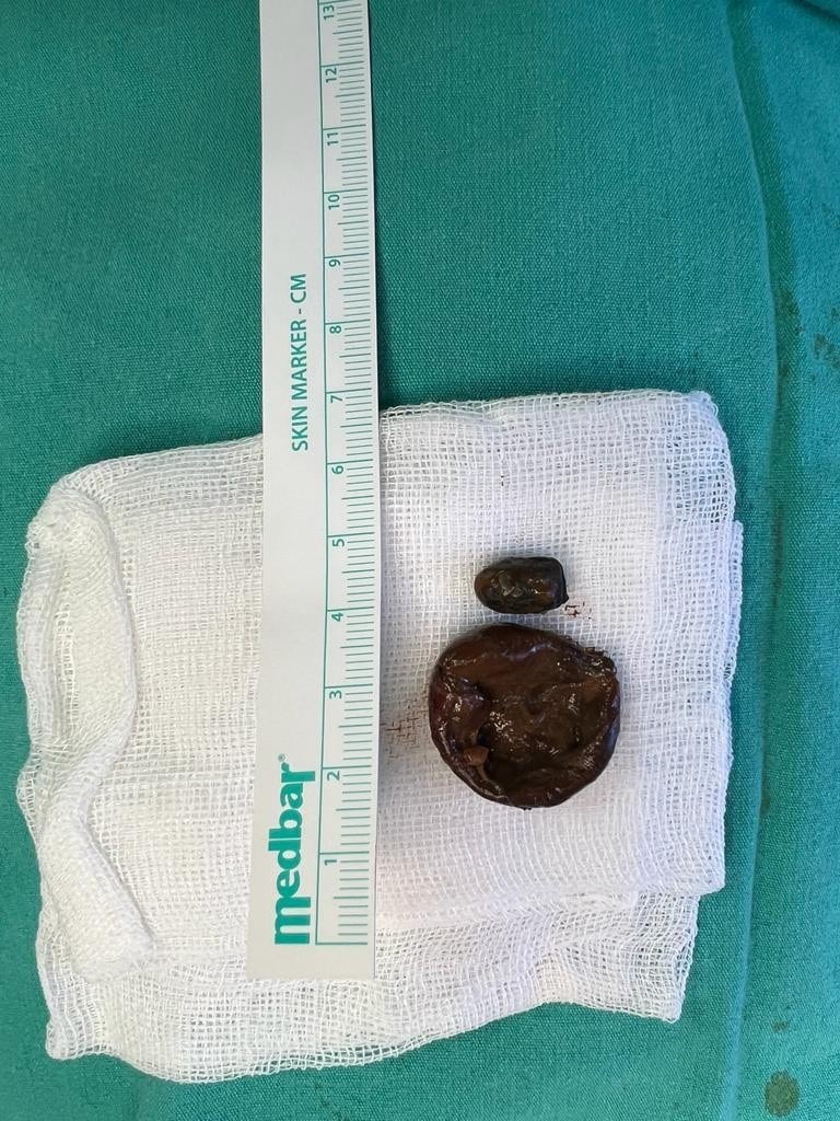 50 Senedir Burnunda Mermiyle Hayat Sürdü