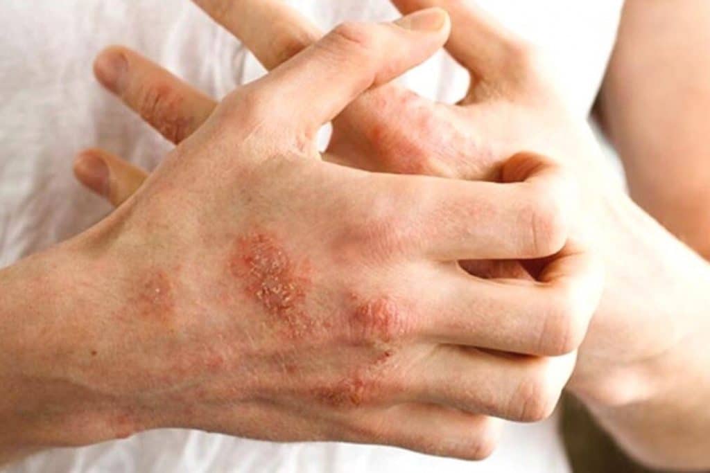 Sonbaharda Alerjik Egzamaya Dikkat Edilmesi Gerekiyor