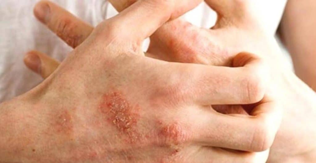 Sonbaharda Alerjik Egzamaya Dikkat Edilmesi Gerekiyor