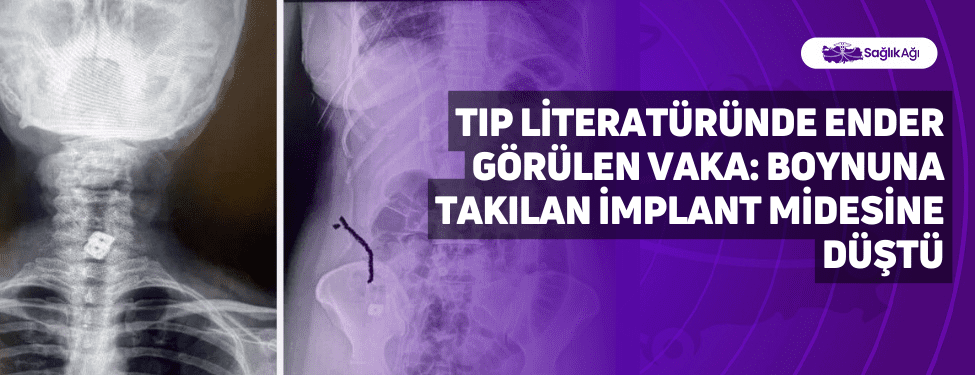 Sultan Tıraş’a (40) boyun fıtığı sebebiyle takılan implantlardan birisi bir