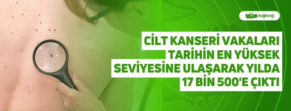 Cilt Kanseri Vakaları Tarihin En Yüksek Seviyesine Ulaşarak Yılda 17 Bin 500'e Çıktı