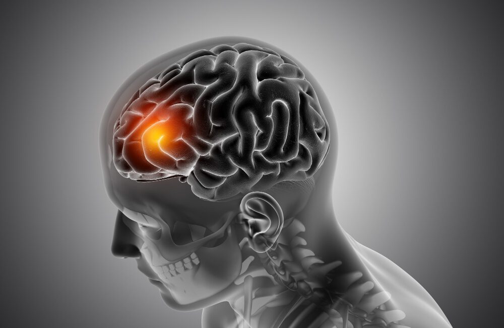İnme (stroke), beyne giden kan akışının ani olarak kesilmesi veya
