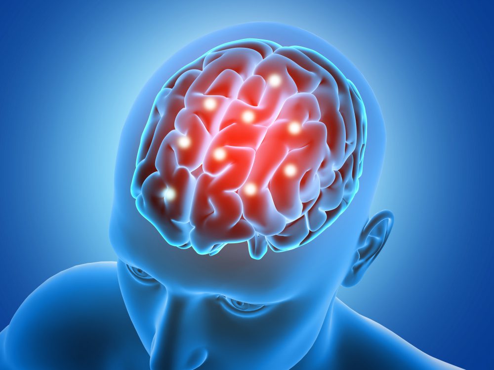 İnme (Stroke): Türleri, Risk Faktörleri, Tedavi ve Rehabilitasyon Yaklaşımları