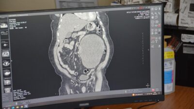 Bitlis’in Adilcevaz ilçesinde yaşayan 56 yaşındaki Vezir Erçetin, karın ağrısı