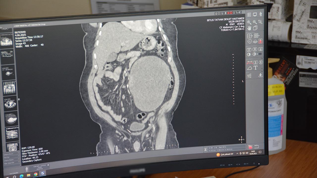 Karın Ağrısı Şikayetiyle Gitti: Böbreğinden 23 Santimlik Dev Kist Çıkarıldı Karın Ağrısı Şikayetiyle Gitti: Böbreğinden 23 Santimlik Dev Kist Çıkarıldı
