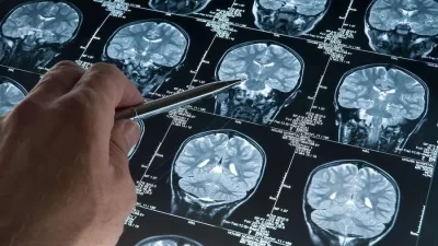 Nörodejeneratif hastalıkların teşhisinde çığır açabilecek bir araştırma, Alzheimer ve Parkinson
