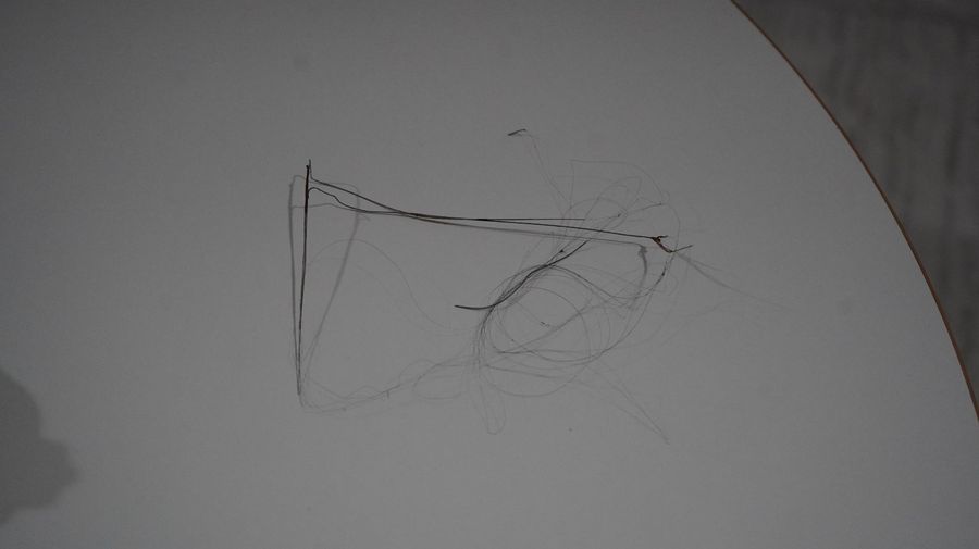 6 Yaşındaki Çocuğun Vücudunda 3 Yıldır 18 Santimlik Kateter Unutuldu salatalik yutunca424