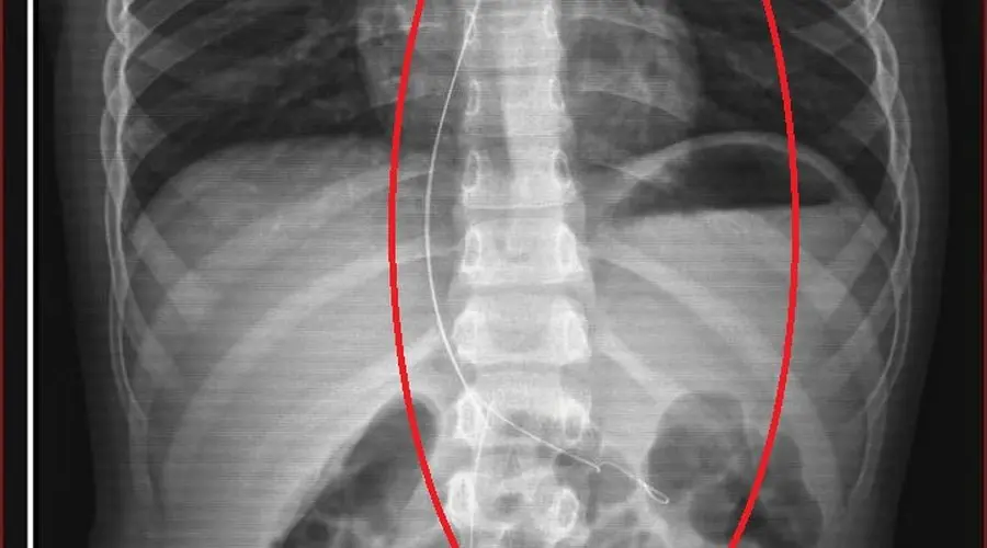 Şırnak’ta yaşayan 6 yaşındaki Aram Devran Ötün’ün vücudunda tam 3