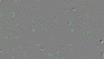 İspanyol bilim insanları, Vibrio cholerae bakterisinin salgıladığı HapA proteininin tümör