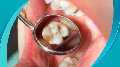 İngiltere’deki Nottingham Üniversitesi’nden bilim insanları, diş minesini yeniden oluşturmaya yardımcı