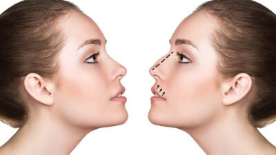 Rinoplasti sonrası burun ucunun aşağıya doğru inmesi sık rastlanmayan bir