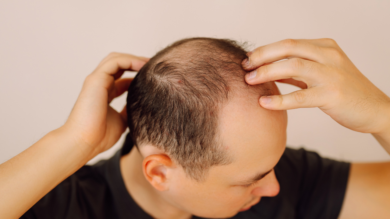 Este Surgery ile Üst Düzey fue Deneyimi ve Gelişmiş fue technique